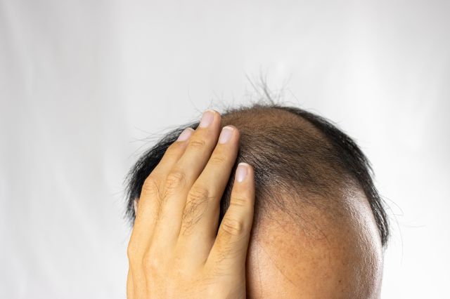 薄毛を気にする男性