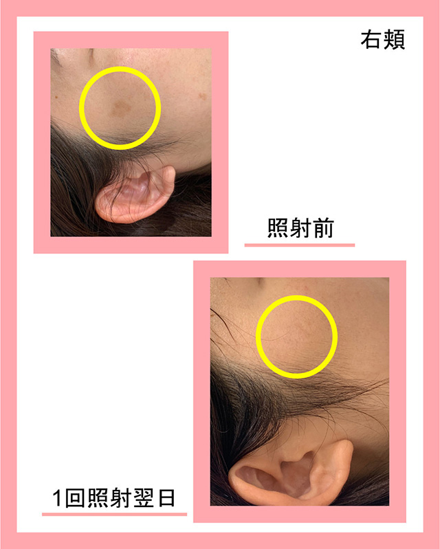 右頬症例